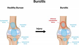 Bursitis Symptoms in Knee