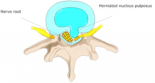 Herniated Cervical Disc