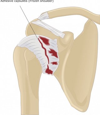 Frozen Shoulder -