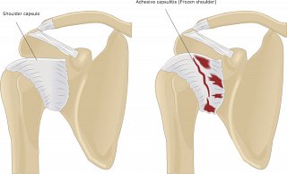Frozen Shoulder Symptoms