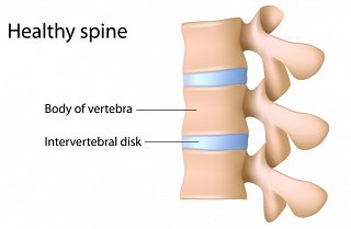 Herniated Disc