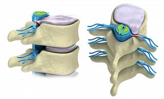 Herniated Disc Illustration