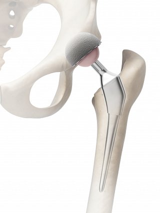 Hip Surgery Recovery