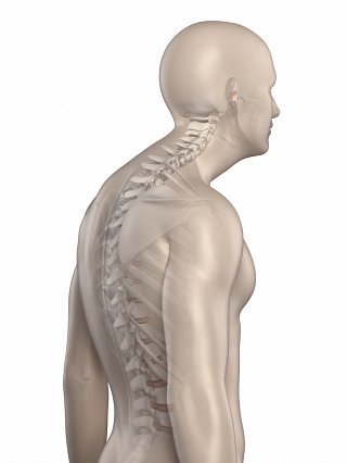 Kyphosis