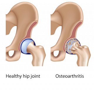 Osteoarthritis in hip