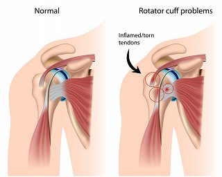 Tendonitis in the Shoulder - rotator cuff