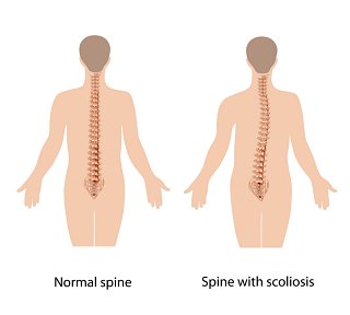 Scoliosis and back pain
