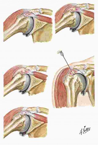 Shoulder surgery Recovery