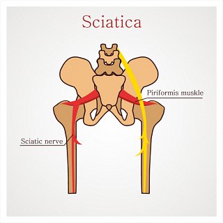 What is Sciatica
