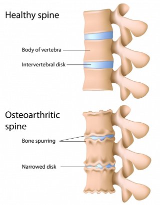 Osteoarthritic Spine image