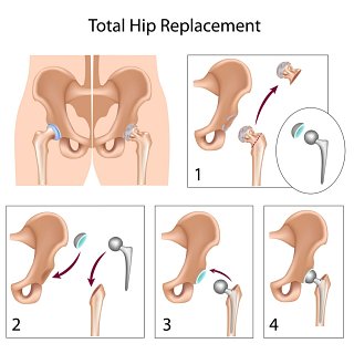 Total Hip Replacement recovery