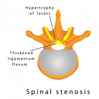 Spinal Stenosis