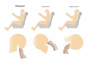 What is Whiplash